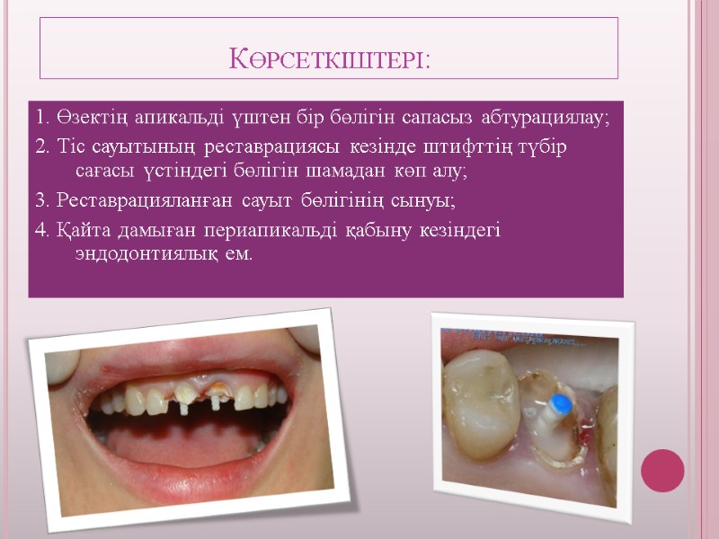 Көрсеткіштері: 1. Өзектің апикальді үштен бір бөлігін сапасыз абтурациялау; 2. Тіс сауытының реставрациясы кезінде